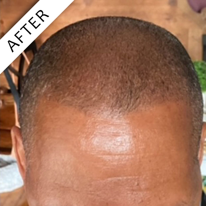  - Scalpology - Scalp Micropigmentation in PA - Scalp Micropigmentation - Scalpology - Scalp Micropigmentation in PA -  - Scalpology - Scalp Micropigmentation in PA - Scalpology - Scalp Micropigmentation in PA - Scalp Micropigmentation - Scalpology - Scalp Micropigmentation in PA -  - Scalpology - Scalp Micropigmentation in PA