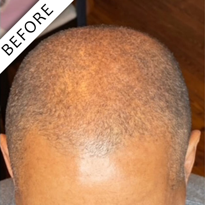  - Scalpology - Scalp Micropigmentation in PA - Scalp Micropigmentation - Scalpology - Scalp Micropigmentation in PA -  - Scalpology - Scalp Micropigmentation in PA - Scalpology - Scalp Micropigmentation in PA - Scalp Micropigmentation - Scalpology - Scalp Micropigmentation in PA -  - Scalpology - Scalp Micropigmentation in PA