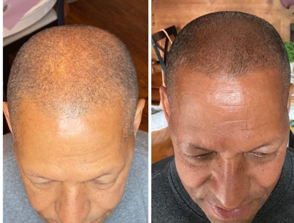  - Scalpology - Scalp Micropigmentation in PA - Scalp Micropigmentation - With Scalp Micropigmentation Restore your hairline -  - 