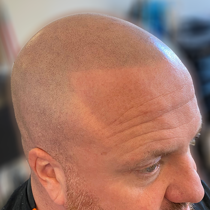  - Scalpology - Scalp Micropigmentation in PA - Scalp Micropigmentation - SERVICES -  -  - Scalpology - Scalp Micropigmentation in PA - Scalp Micropigmentation - SERVICES -  - 