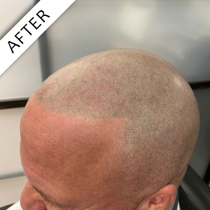  - Scalpology - Scalp Micropigmentation in PA - Scalp Micropigmentation - Scalpology - Scalp Micropigmentation in PA -  - Scalpology - Scalp Micropigmentation in PA - Scalpology - Scalp Micropigmentation in PA - Scalp Micropigmentation - Scalpology - Scalp Micropigmentation in PA -  - Scalpology - Scalp Micropigmentation in PA