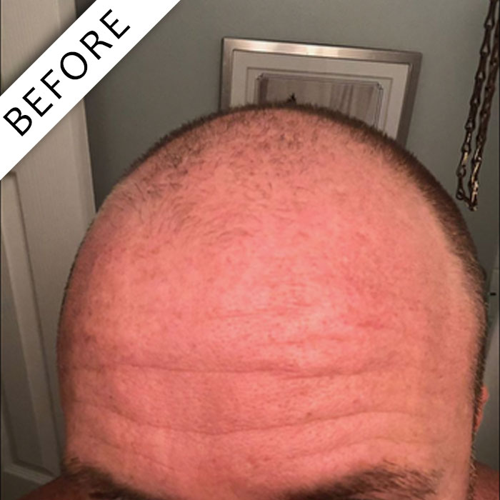  - Scalpology - Scalp Micropigmentation in PA - Scalp Micropigmentation - Scalpology - Scalp Micropigmentation in PA -  - Scalpology - Scalp Micropigmentation in PA - Scalpology - Scalp Micropigmentation in PA - Scalp Micropigmentation - Scalpology - Scalp Micropigmentation in PA -  - Scalpology - Scalp Micropigmentation in PA